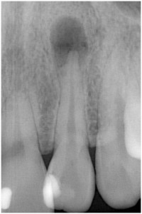 小泉②-1　歯髄壊死　◎